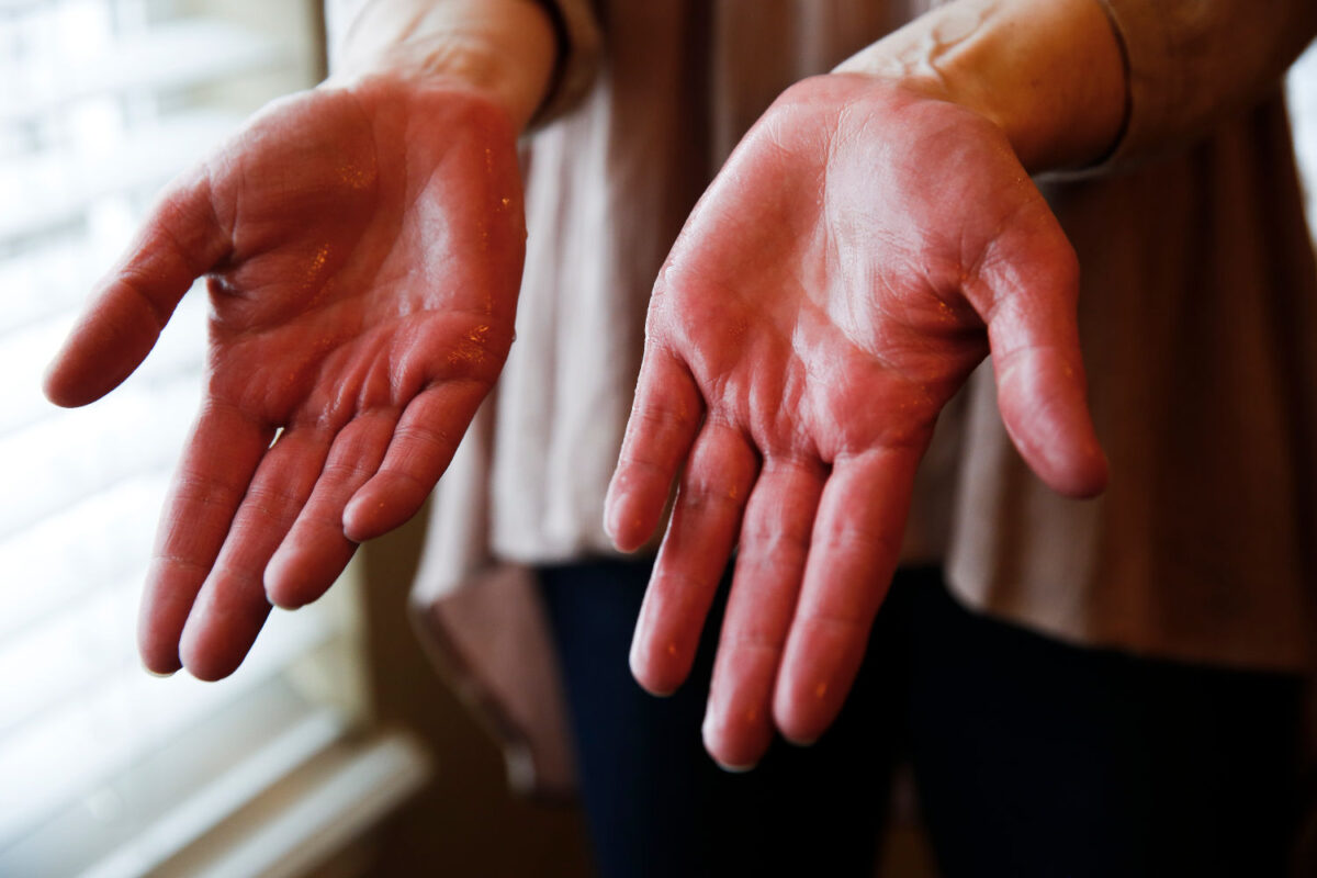 No sweat Surgery relieves problems of excessively sweaty palms News